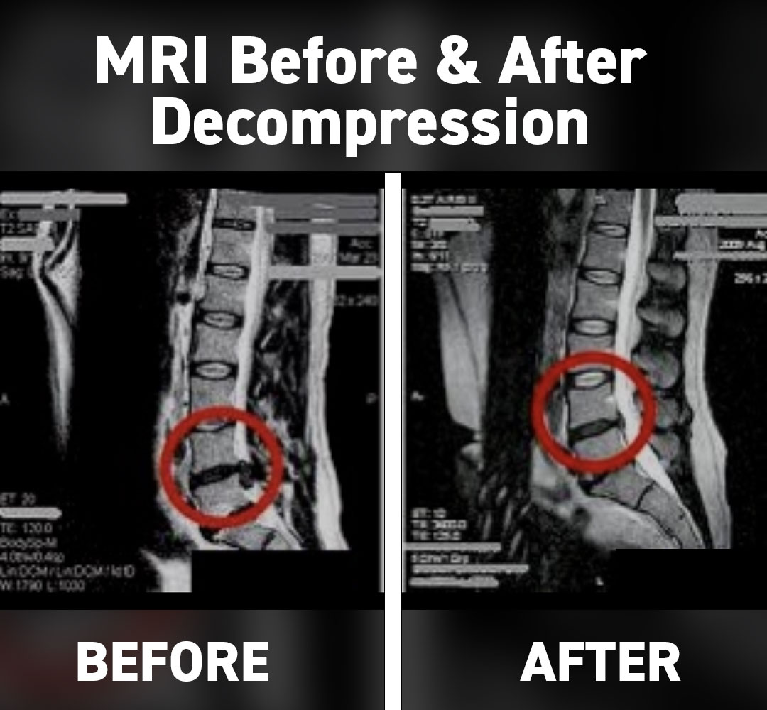 MRI Before and After Decompression