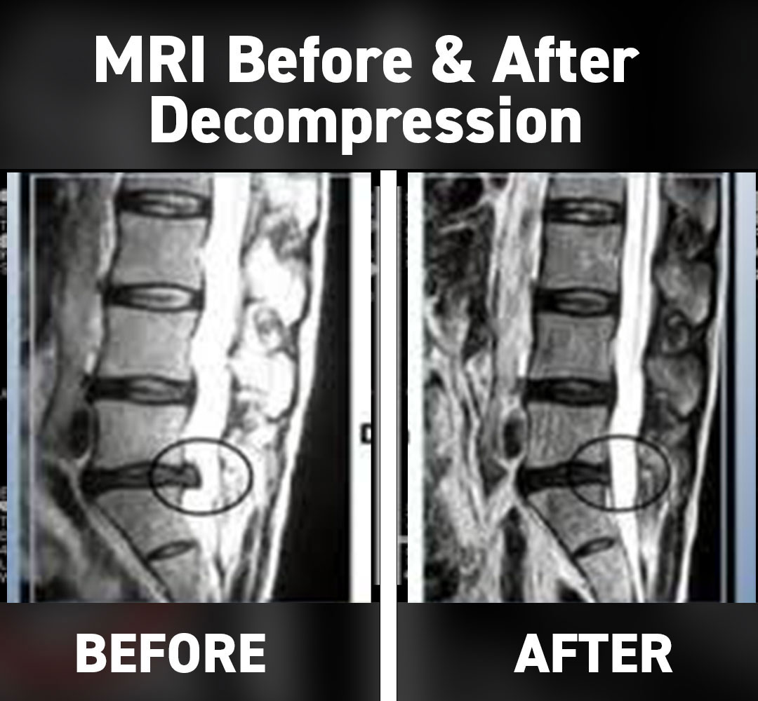 Disc Herniation & Bulging Relief - Non-Surgical Non-Drug Back Pain